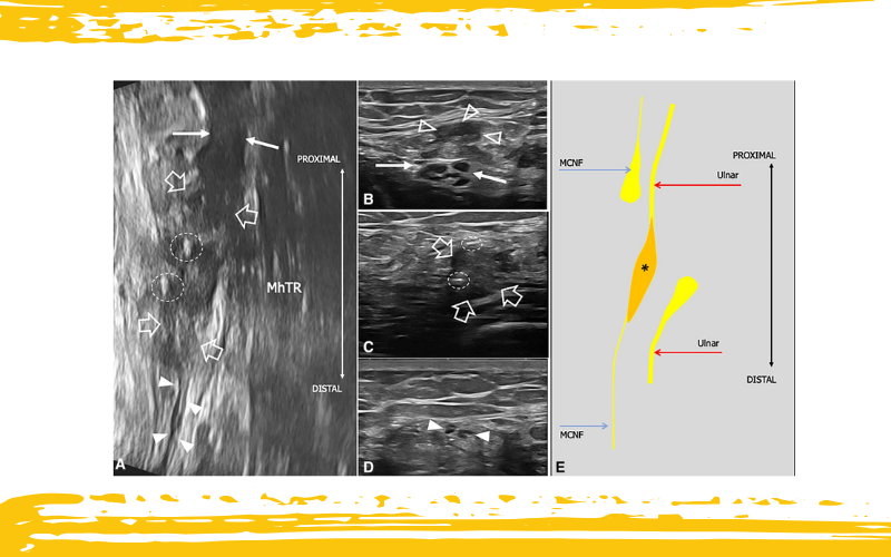 3. Nervio cutaneo medial antebrazo tempo formacion.png